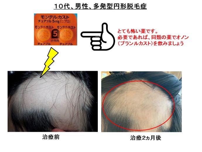 円形脱毛症　病院